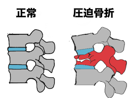 圧迫骨折イラスト.png